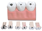 Показать информацию о Кариес зубов - 7 частей - 4x 1 шт.