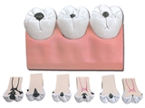 Show details for  DENTAL CARIES - 7 parts - 4x 1pcs