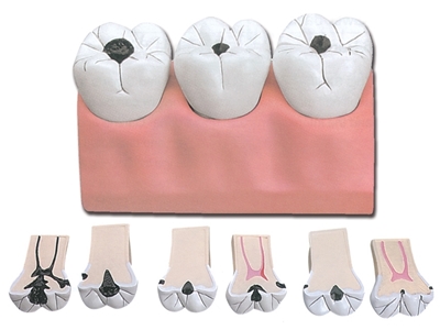 Picture of  DENTAL CARIES - 7 parts - 4x 1pcs