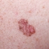 Picture of LuxaScope CCT dermatoskops bez mērogošanas